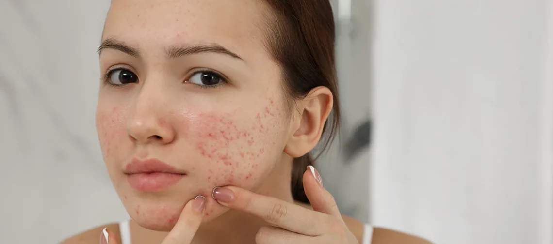 Check the labels! Typically, products that cause purges are exfoliants or contain ingredients such as: